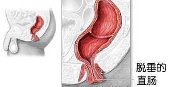 直肠脱垂发病因素有哪些?合肥医博肛泰医院