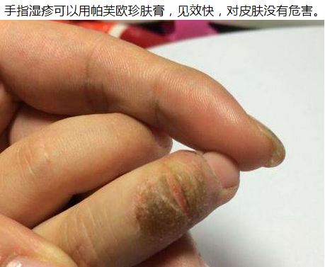手指皲裂湿疹,了解症状有效预防湿疹的方法