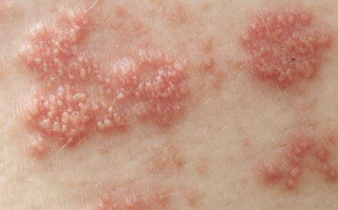 皮肤过敏有什么症状 这五个最常见