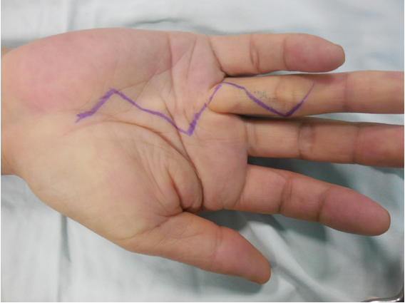 据介绍,掌腱膜挛缩症(dupuytren s contracture)是一种侵犯掌腱膜