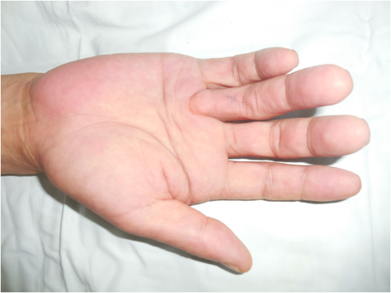 据介绍,掌腱膜挛缩症(dupuytren s contracture)是一种侵犯掌腱膜