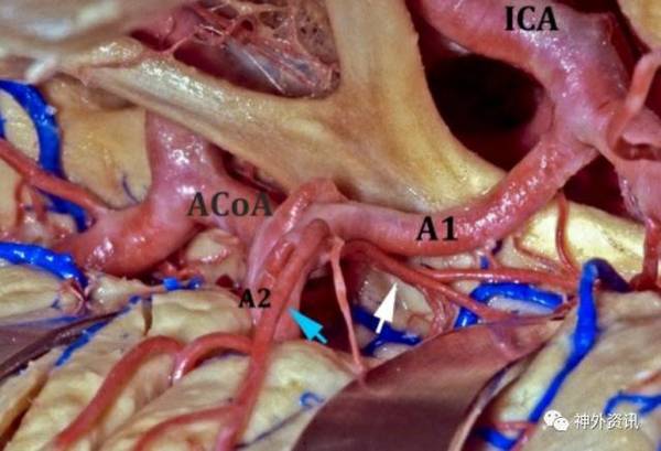 前交通动脉瘤手术要点| the neurosurgical atlas全文