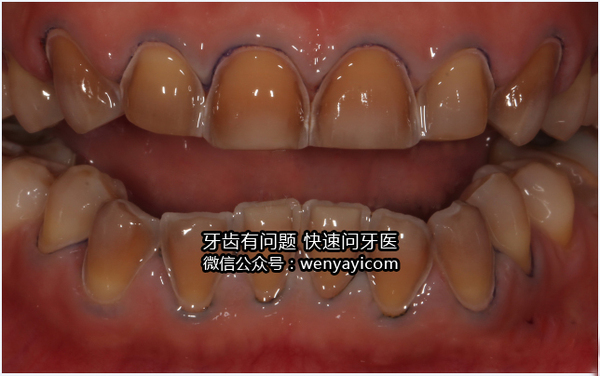 重度四环素牙治疗前后对比图集