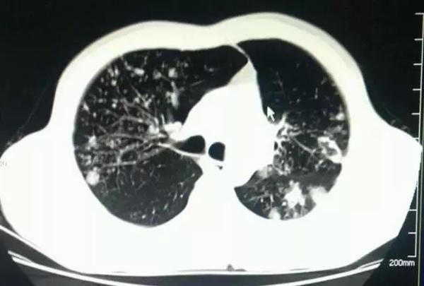 患者胸闷气短,检查后竟是继发型肺结核