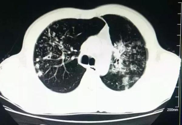 患者胸闷气短,检查后竟是继发型肺结核