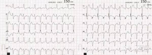 一例典型的洋地黄型 st 鱼钩样改变 洋地黄中毒易出现何种心律