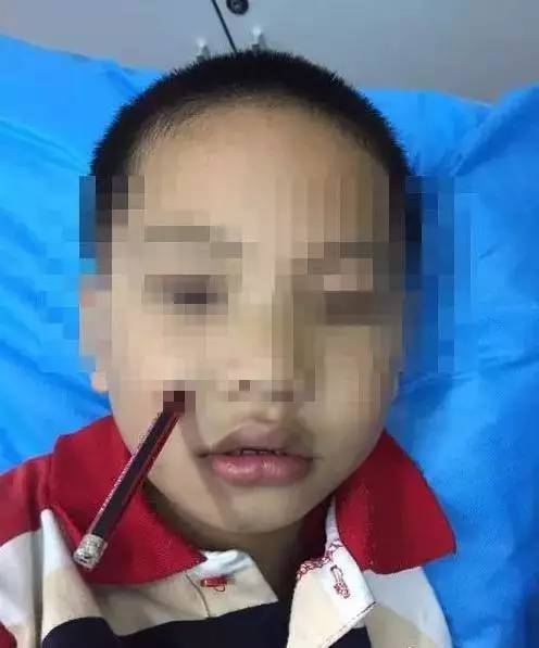 苏州7岁男孩被笔尖戳进眼球!差一毫米就失明了