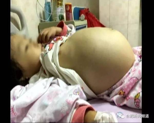 来自六安霍山的小女孩仅仅3岁 因为患有罕见疾病 使她的肚子涨得像