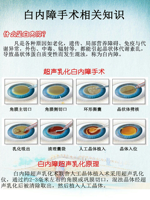 新技术| 白内障透明角膜切口超声乳化手术