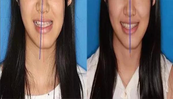 牙齿矫正对一个人外貌影响有多大