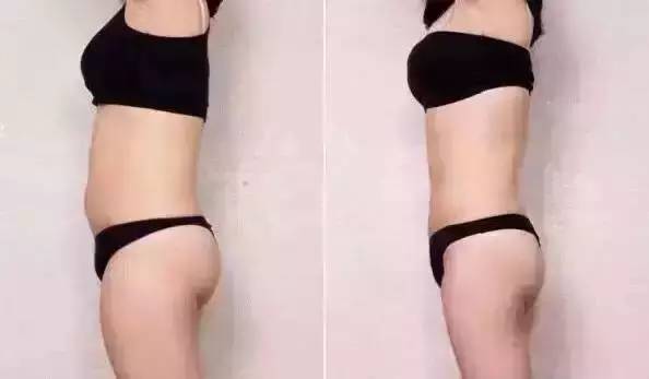抽脂排名_抽脂手术(2)