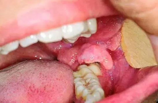 炎症初期,病人觉得牙龈肿胀疼痛,咀嚼吞咽或开口活动时疼痛明显,随着