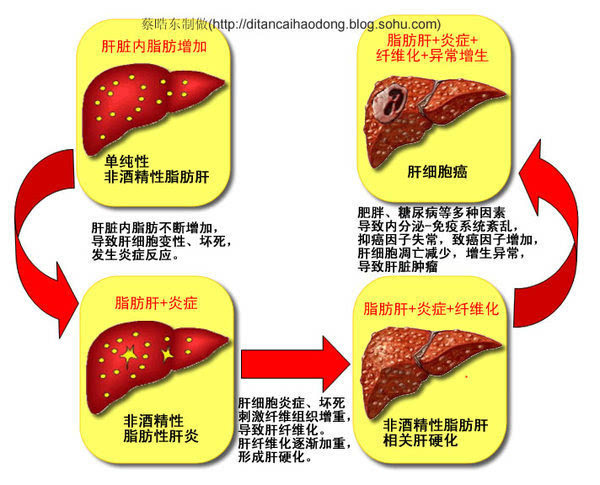 全球4个人中就有1个脂肪肝!