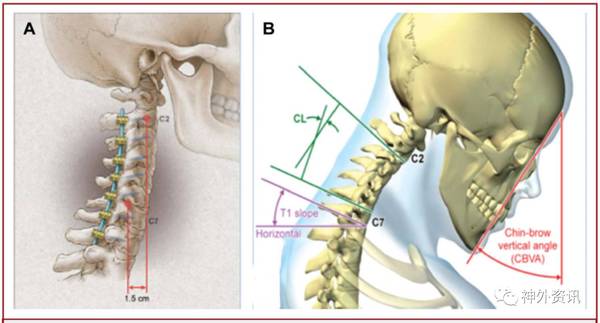 图1. acd患者入选标准:颈椎各个径线的示意图.