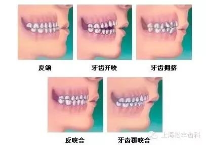 上海矫正牙齿的误区