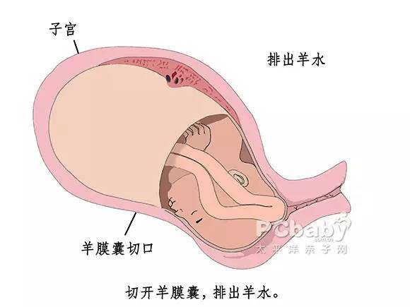 缩宫素子宫收缩作用妇产科