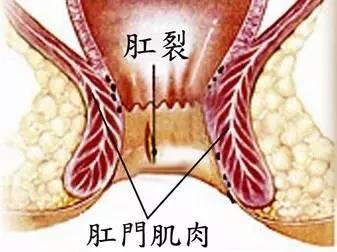 直肠粘膜脱垂,直肠炎,内痔嵌顿,盆腔炎,前列腺炎等都可能会引起肛门坠