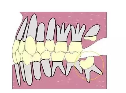 9.恒牙不萌出或埋伏阻生