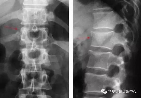 椎体压缩骨折应该怎么检查才不耽误治疗?