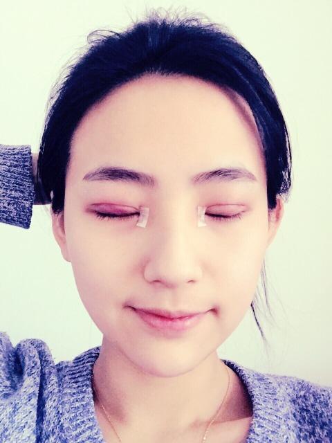 双眼皮手术想割就割了，在意别人的眼光干什么