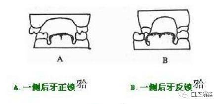 com 来源:江子任,潘超已获作者授权 锁合是后牙的一种错合畸形,根据