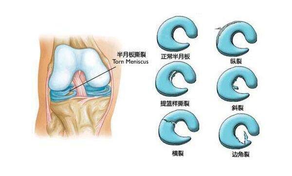 关节肿胀,弹响和交锁,打软腿以及在膝关节间隙或半月板部位有明确的