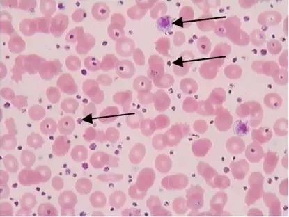 血小板:散落或聚集分布于红细胞周围,直径约1-3μm,灰蓝色略粗糙胞浆