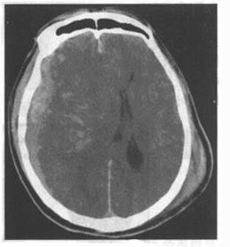 颅脑外伤读片技巧,影像科医生急诊必备!