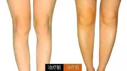 针对于膝盖内侧较为突出这个问题其实很好解决,将膝盖下方的 进行脂肪