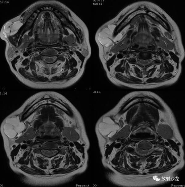 病例学习 | 颊部淋巴管瘤一例