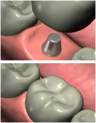 种植牙过程 你了解吗?