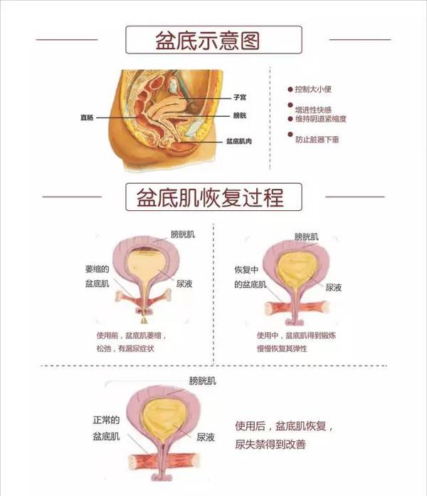 产后盆底康复,真正的未雨绸缪