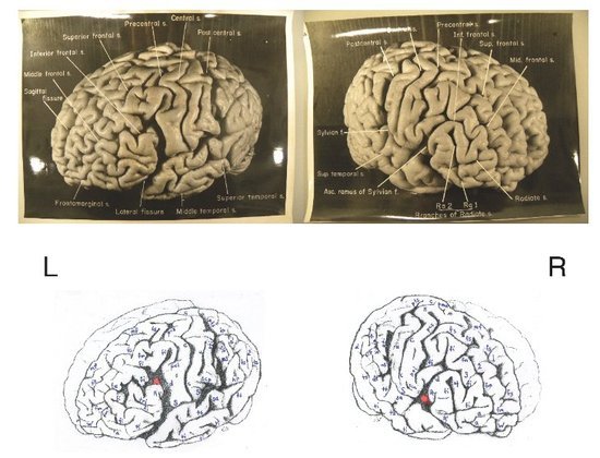 病理学家托马斯·哈维旋即对遗体进行了解剖,并摘除了爱因斯坦的大脑