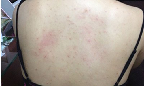 引起背部长痘的主要原因有三个