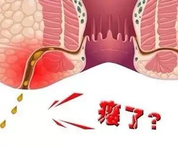 肛瘘知多少?现在就告诉你所有真相