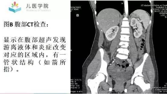 病例讨论 第78期丨盲肠憩室炎