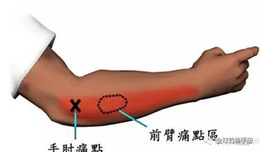 9.局部封闭:在肘关节特定部位注射可的松类药物可以消炎,止痛.