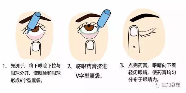 若同时使用两种眼药水,一般需要间隔5分钟左右再滴另外一种.