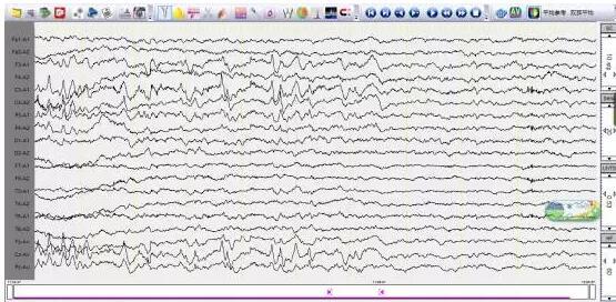 但是有一部分患者则需加做蝶骨电极脑电图,这种脑电图的检测效果更好