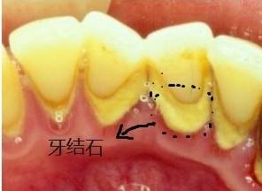 的 糜状物, 以及一部分 食物残渣, 同时会在牙齿周围慢慢形成牙菌斑