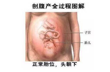 剖腹产手术全过程,女人真的太伟大了!