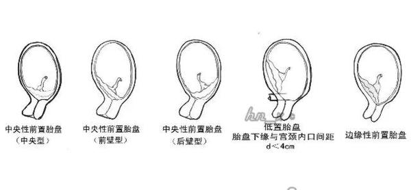 低置胎盘图片_纵览新闻