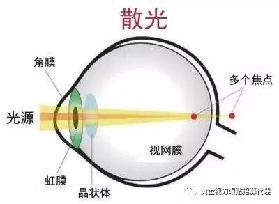当"近视"遇上"散光",你只需要做的是?