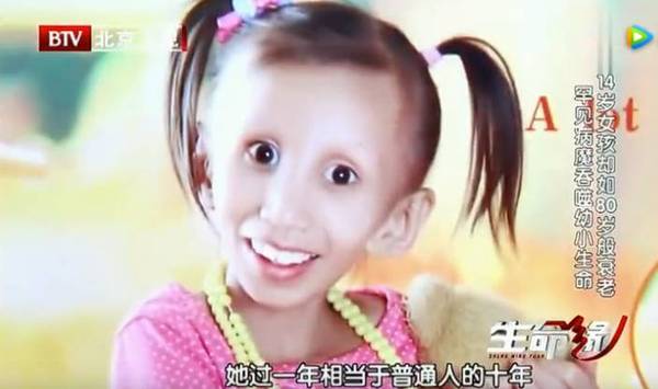 早衰症小女孩桐桐治疗用的 胎盘间充质
