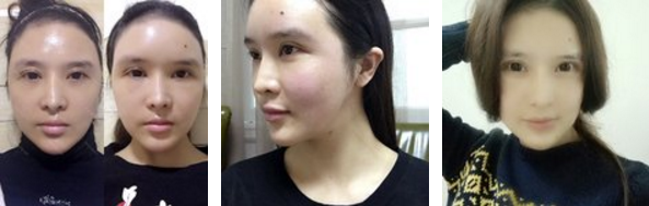 自体脂肪填充额头 照片没ps就这么完美了