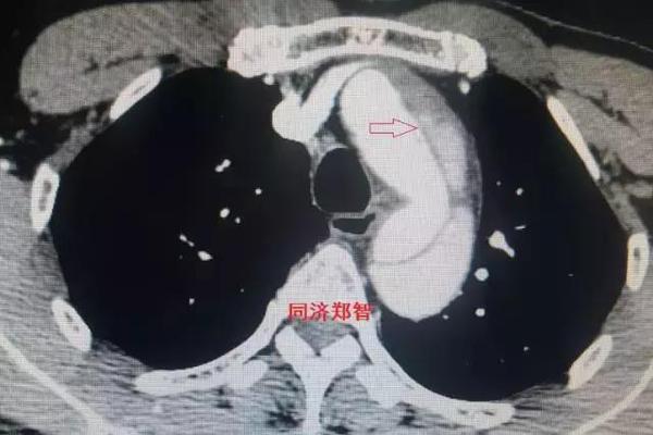 在某些特殊情况下,主动脉夹层及主动脉壁间血肿的平扫ct中也可以显示