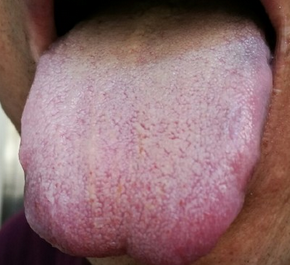 紫红舌,伴瘀癍,来自肝癌患者