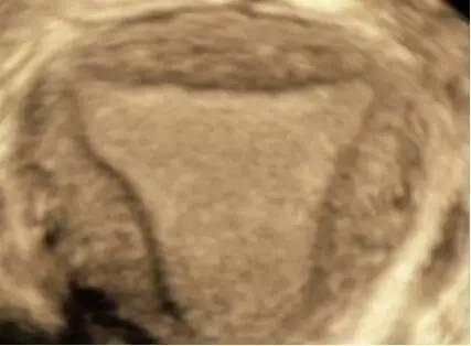 子宫纵切面和子宫横切面 可用三维超声显示出子宫冠状切面.