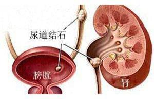 就容易发生尿石症,确诊结石的患者可服用《排安茶》,可以调整身体的