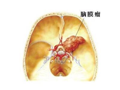 为什么会脑瘤 a4ndo701603219688405.jpg